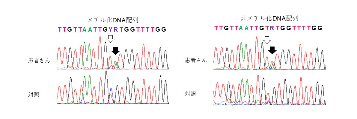 図３　患者さんのX染色体不活化パターンの推測